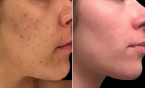 Dermapen Öncesi Ve Sonrası